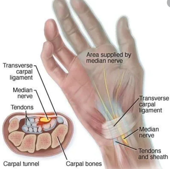 Carpal Tunnel Defined